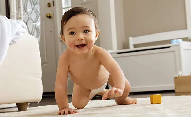 crawling baby with eczema on cheeks